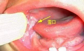 宝宝口腔里有白色奶块还酸味,宝宝口腔里有白色奶状物