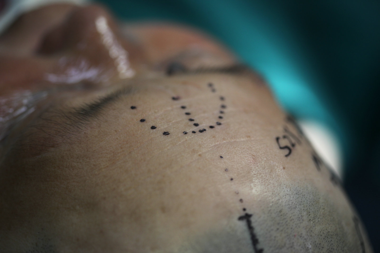 神经外科纪实视频,显微神经外科手术费用