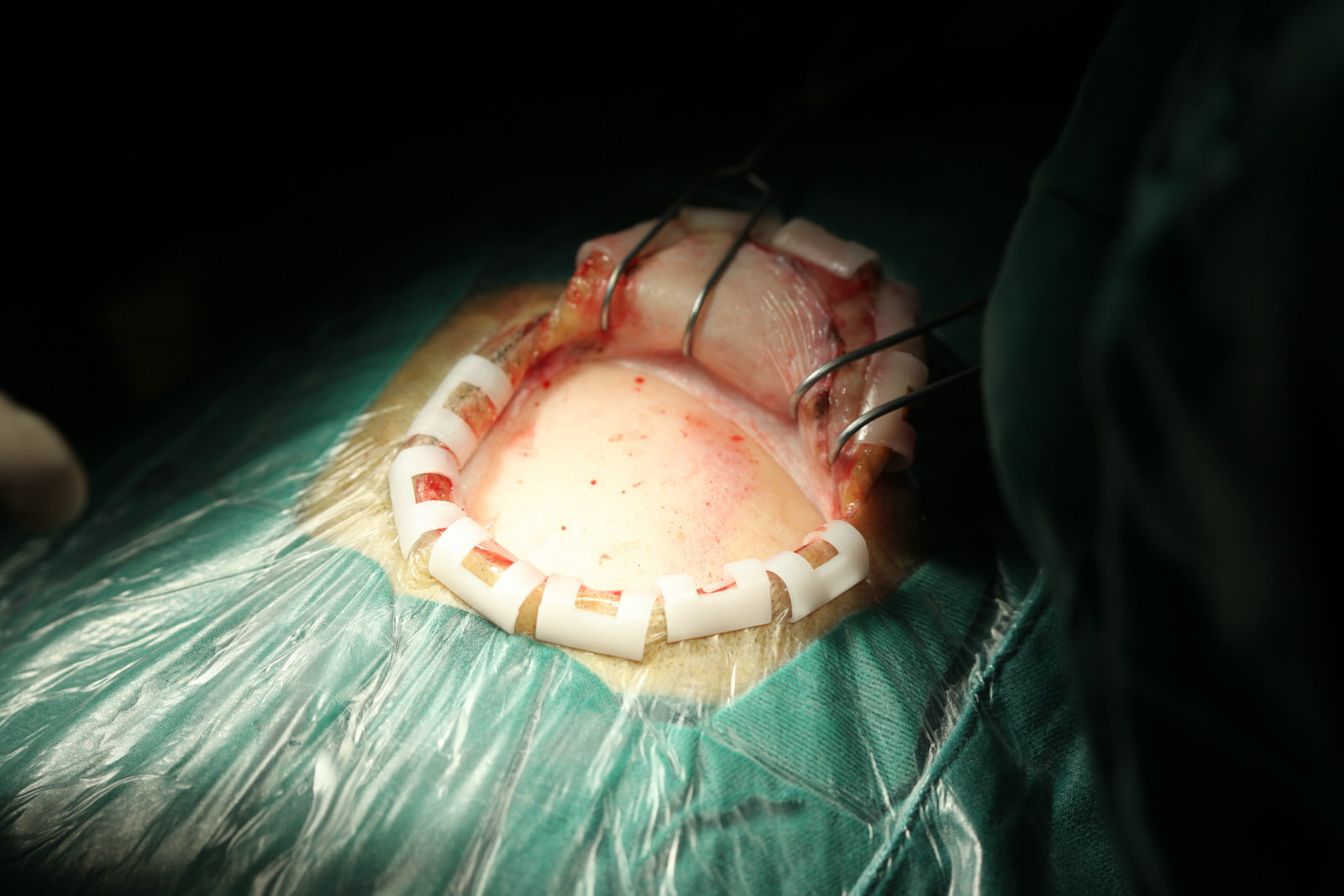 神经外科纪实视频,显微神经外科手术费用