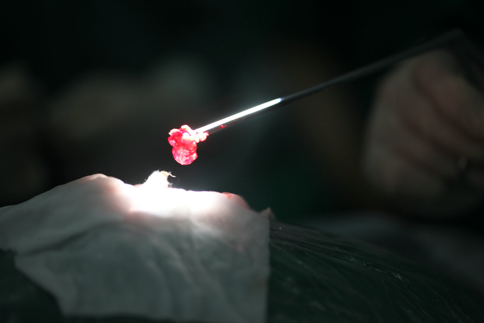 神经外科纪实视频,显微神经外科手术费用