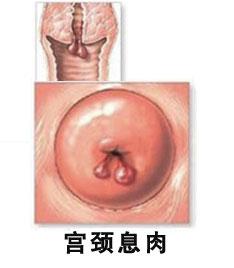预防宫颈息肉的注意事项有哪些,宫颈息肉健康宣教指导方案