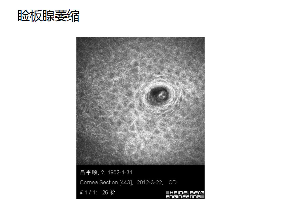 眼睑缘炎的发病原因,眼睑炎的症状和治疗方法