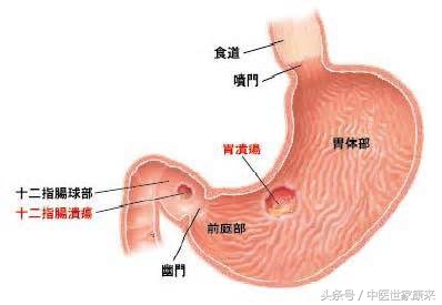 溃疡病柑橘用药,溃疡病症状表现