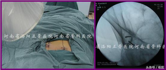 经皮置入术在骨盆髋臼骨折治疗中的应用骨医小灶第二十一期(中)