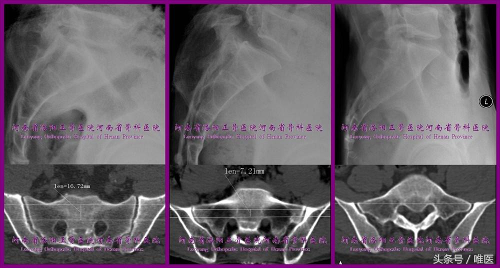 骶髂关节螺钉植入,骶髂关节螺钉手术技巧
