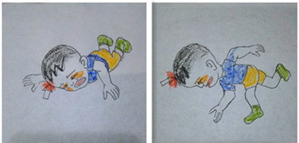 颅骨凹陷性骨折复位视频,儿童鼻骨骨折做手术是微创手术吗