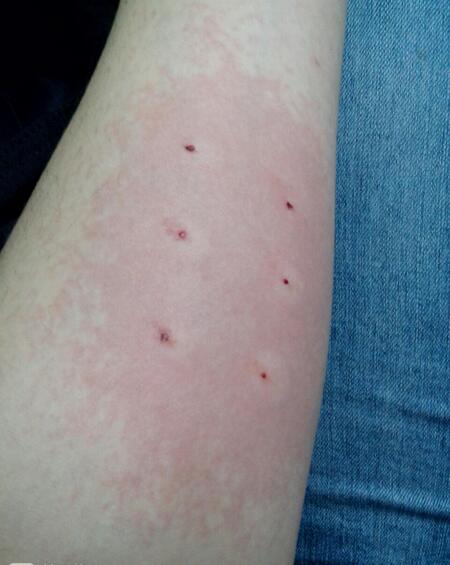 有胎停史再次怀孕有必要查免疫么,胎停免疫治疗多少钱一次