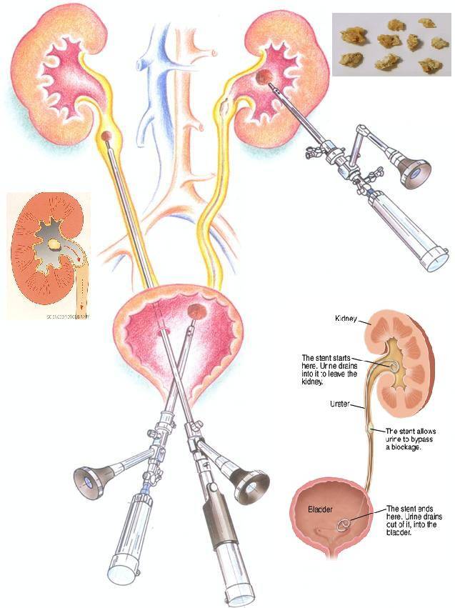 微创肾镜下肾结石碎石取石术,经皮肾镜肾结石激光碎石全过程