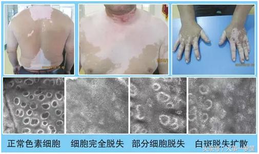 肖海靖点评：白癜风三大伴发疾病你知道多少？