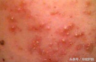 丘疹型痘痘怎么治疗,丘疹型痘痘怎么治疗最彻底