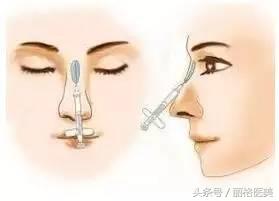 玻尿酸隆鼻一定会变宽吗,玻尿酸隆鼻变宽可以打溶解酶吗