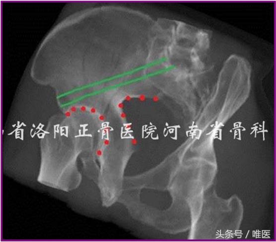 经皮置入术在骨盆髋臼骨折治疗中的应用骨医小灶第二十一期(中)