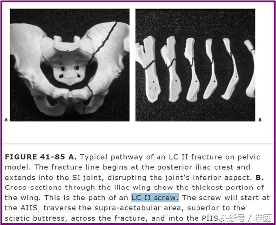 经皮置入术在骨盆髋臼骨折治疗中的应用骨医小灶第二十一期(中)