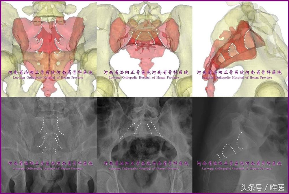 骶髂关节螺钉植入,骶髂关节螺钉手术技巧