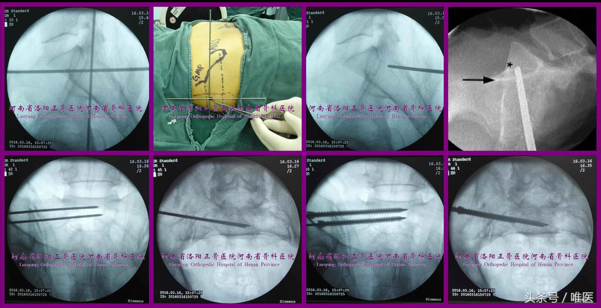 骶髂关节螺钉植入,骶髂关节螺钉手术技巧