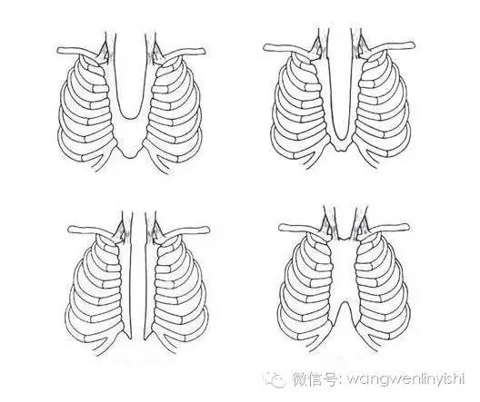 图与真相:什么是胸骨裂?