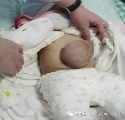 图与真相:什么是胸骨裂?