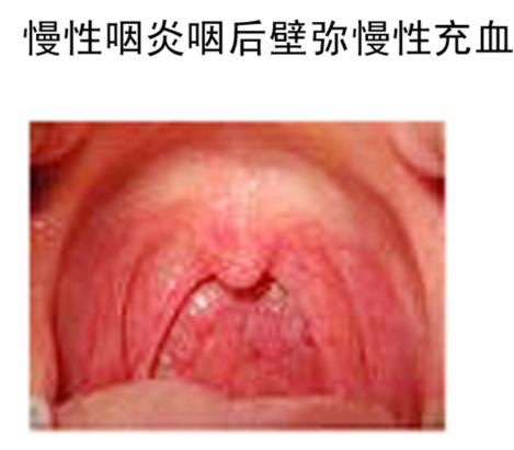 和慢性咽炎说“分手”，方法其实很简单！