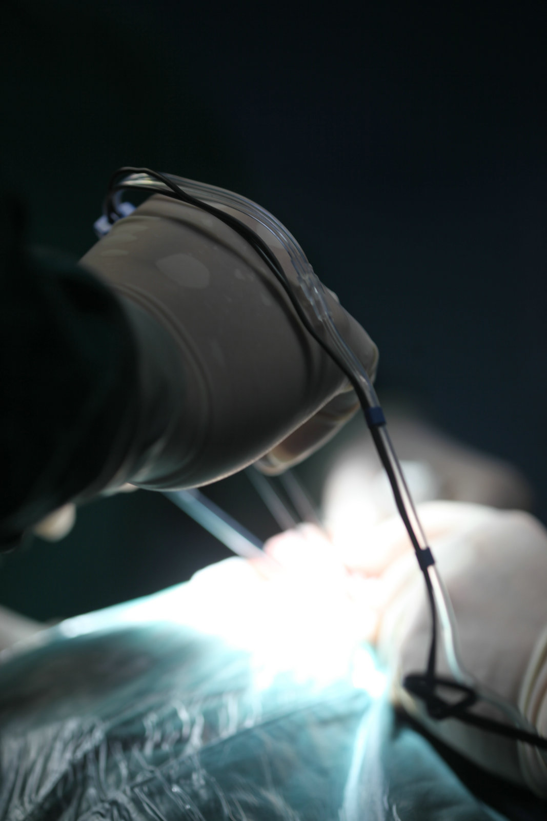 神经外科纪实视频,显微神经外科手术费用