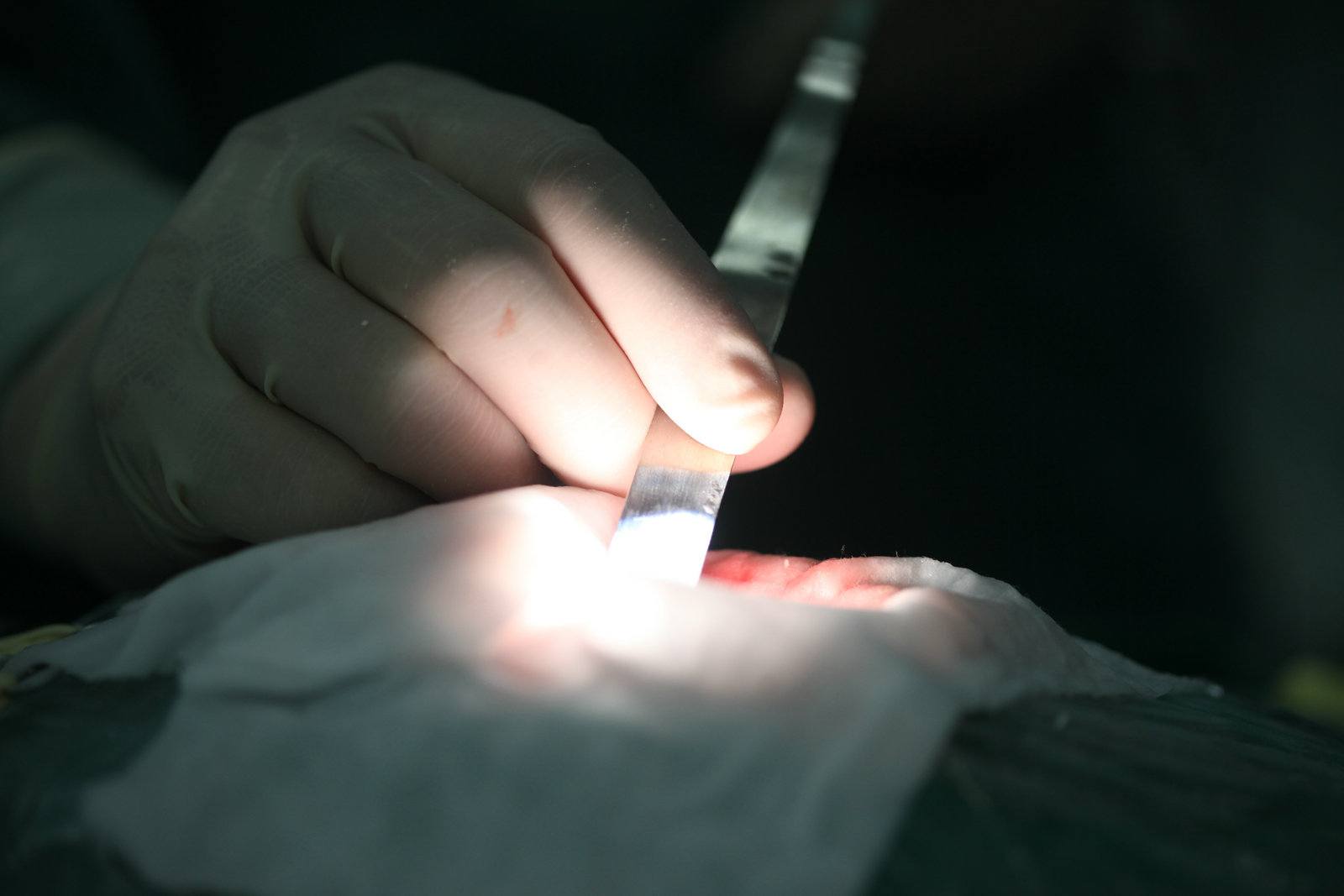 神经外科纪实视频,显微神经外科手术费用