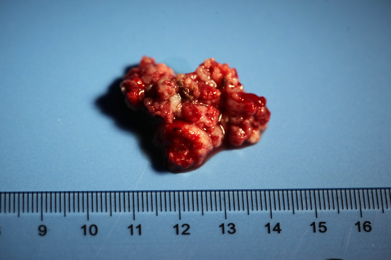 神经外科纪实视频,显微神经外科手术费用