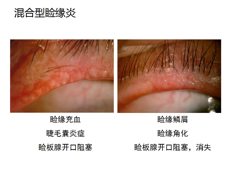 眼睑缘炎的发病原因,眼睑炎的症状和治疗方法