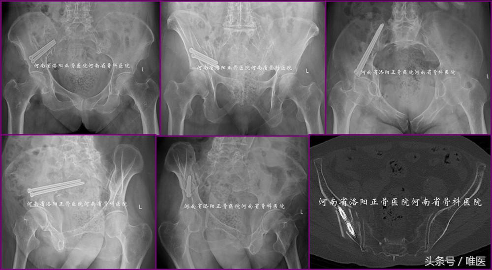 经皮置入术在骨盆髋臼骨折治疗中的应用骨医小灶第二十一期(中)