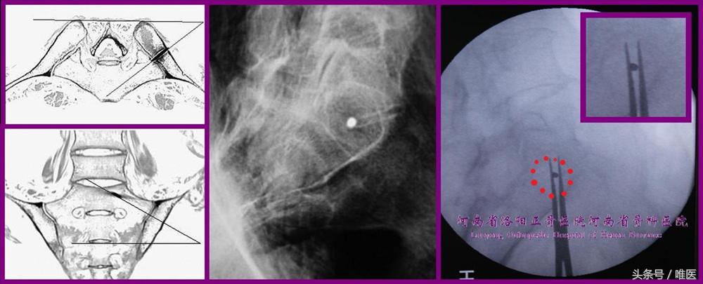 骶髂关节螺钉植入,骶髂关节螺钉手术技巧