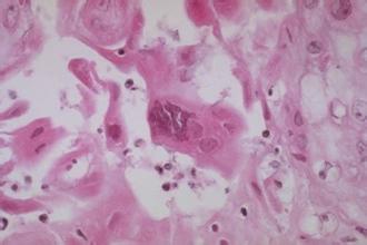 单纯疱疹不“单纯”，小小病毒危害深！