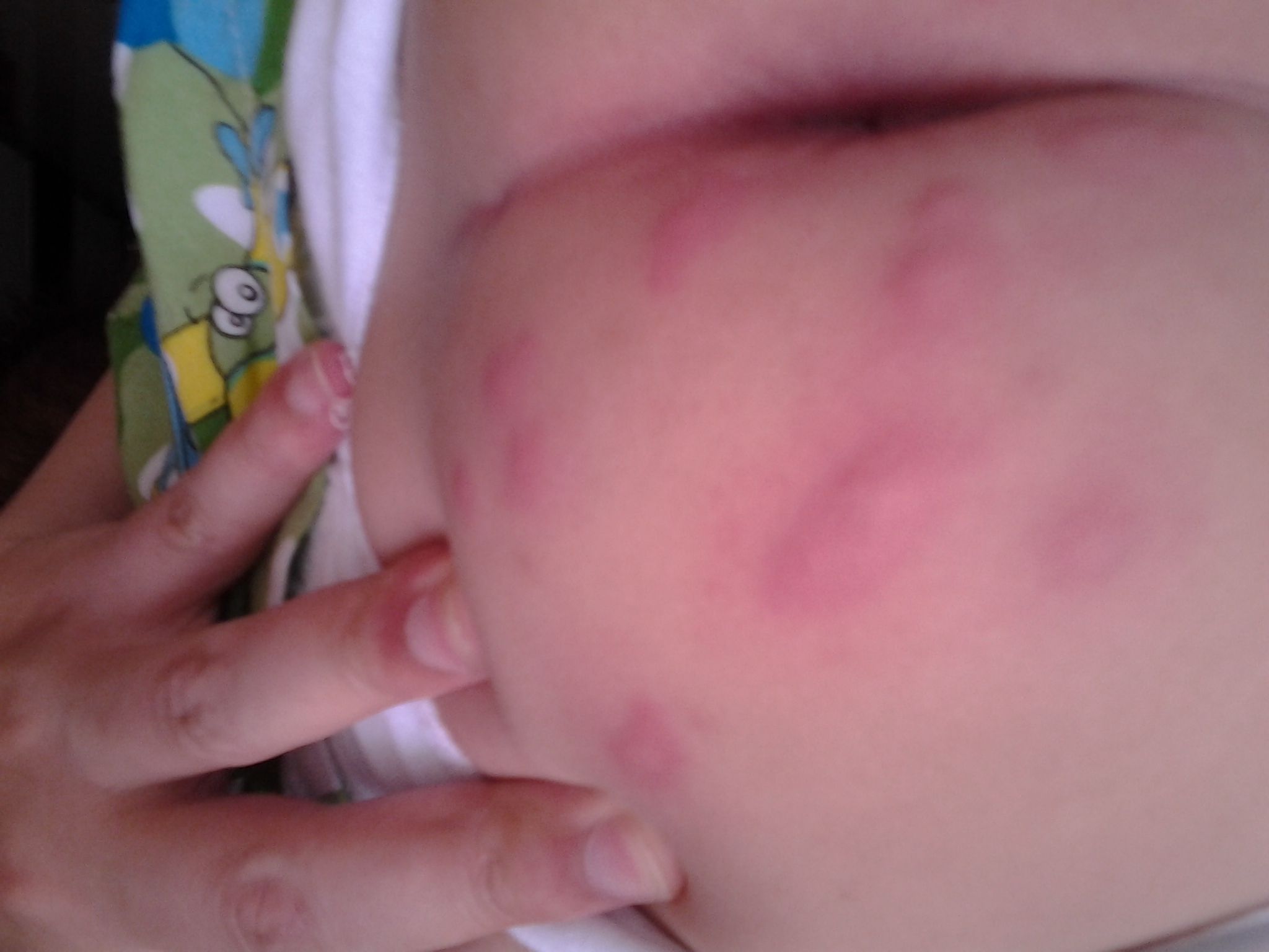 秋天宝宝屁股起红疙瘩,宝宝屁股上长瘊子怎么办