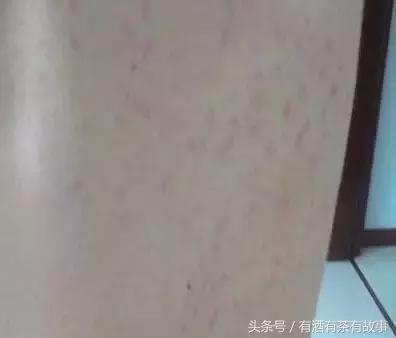 湿疹过敏超级痒,宝宝过敏湿疹妈妈怎么忌口