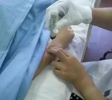 手腕腱鞘炎的艾灸疗法,手腕腱鞘炎艾灸哪个穴位