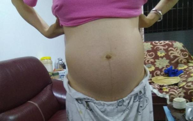 妇产科医生告诉你孕肚长毛，是否生男孩子！