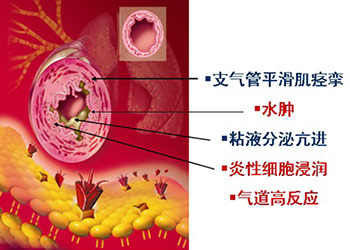 过敏性喘息性支气管炎严重后果,过敏性支气管炎严重吗