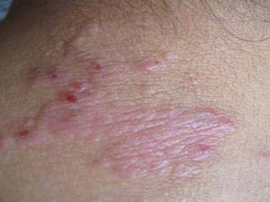 神经性皮炎痒怎么回事,神经性皮炎痒得厉害怎么办