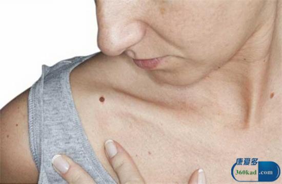 得皮肤癌会有哪些症状？常吃一物预防它