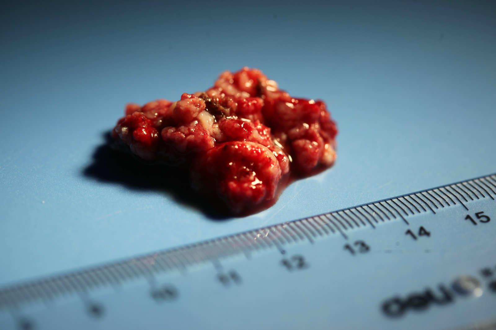 神经外科纪实视频,显微神经外科手术费用