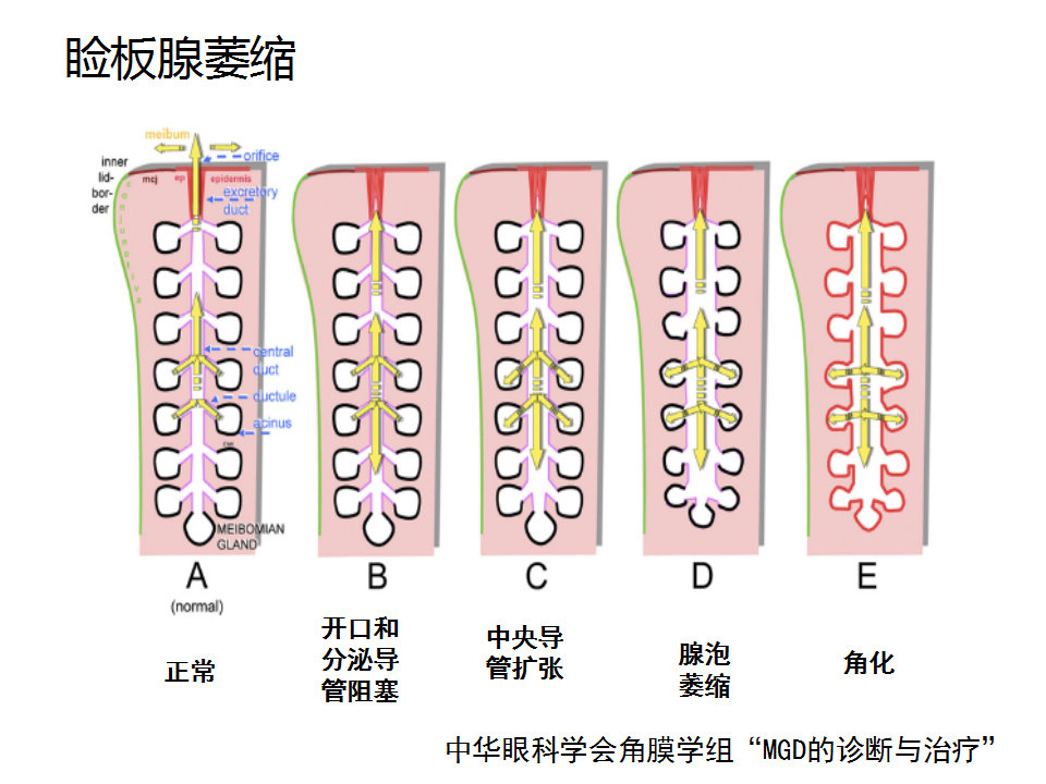 眼睑缘炎的发病原因,眼睑炎的症状和治疗方法
