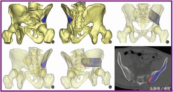 经皮置入术在骨盆髋臼骨折治疗中的应用骨医小灶第二十一期(中)