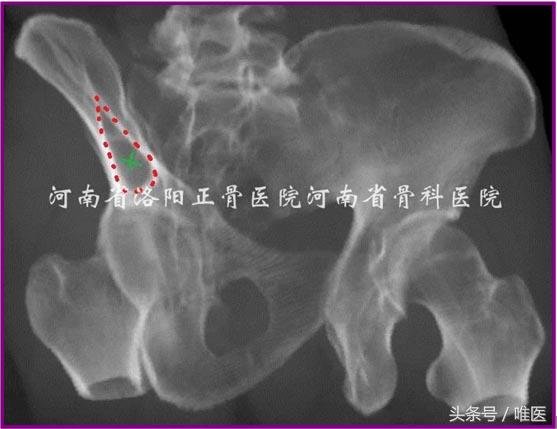 经皮置入术在骨盆髋臼骨折治疗中的应用骨医小灶第二十一期(中)