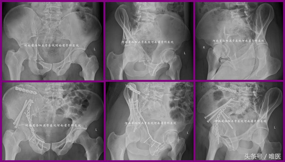 经皮置入术在骨盆髋臼骨折治疗中的应用骨医小灶第二十一期(中)