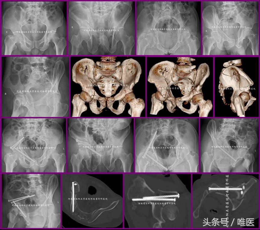 经皮置入术在骨盆髋臼骨折治疗中的应用骨医小灶第二十一期(中)