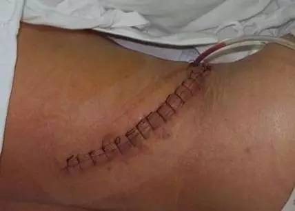 微创肾镜下肾结石碎石取石术,经皮肾镜肾结石激光碎石全过程