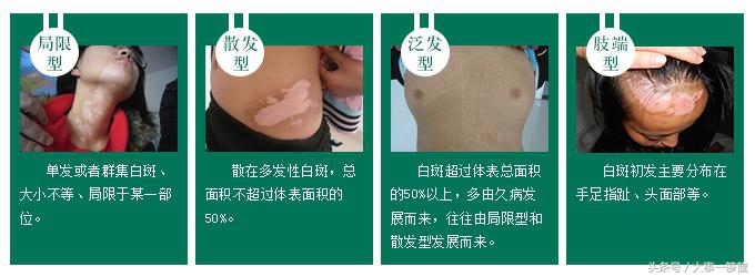 肖海靖点评：白癜风三大伴发疾病你知道多少？