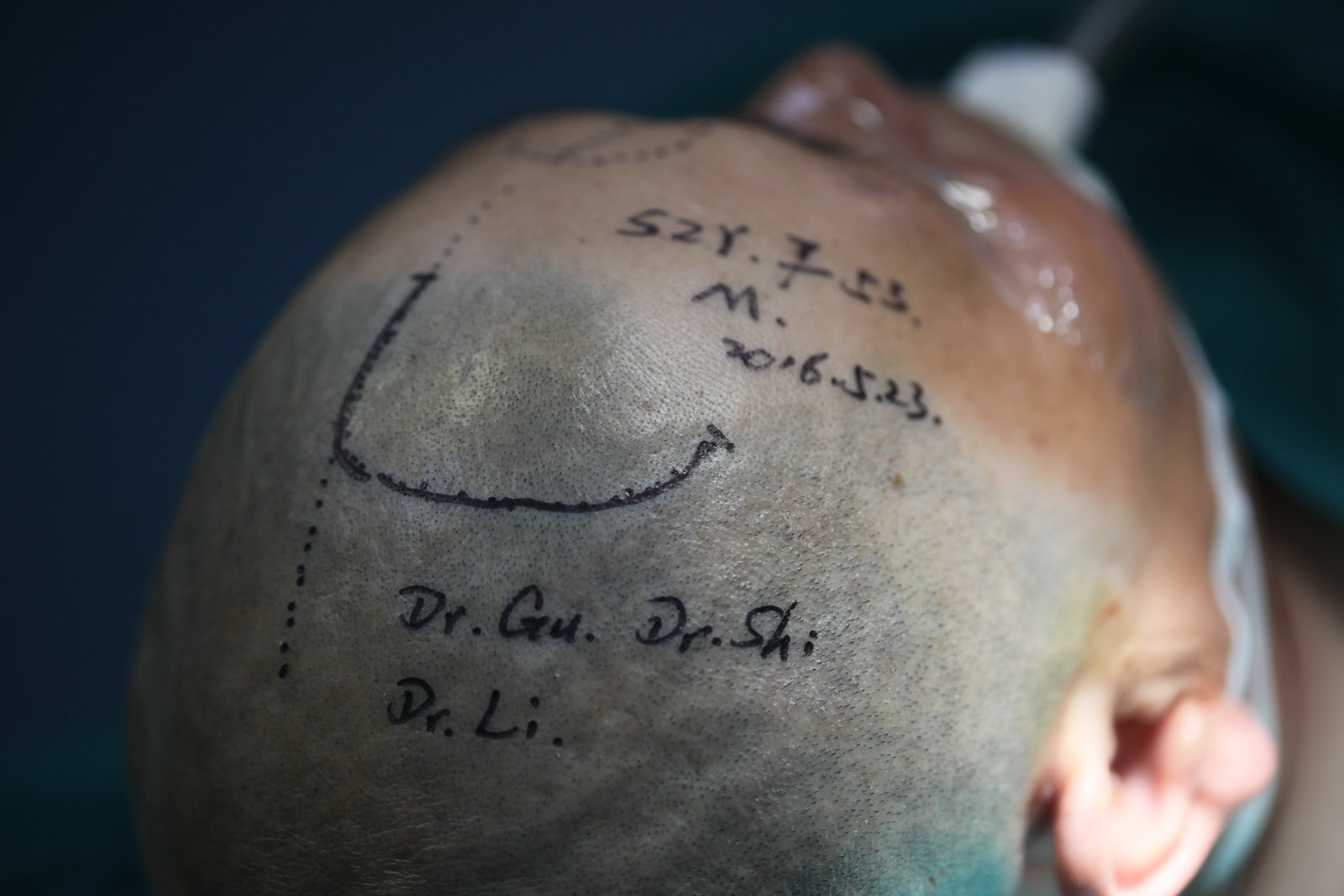 神经外科纪实视频,显微神经外科手术费用