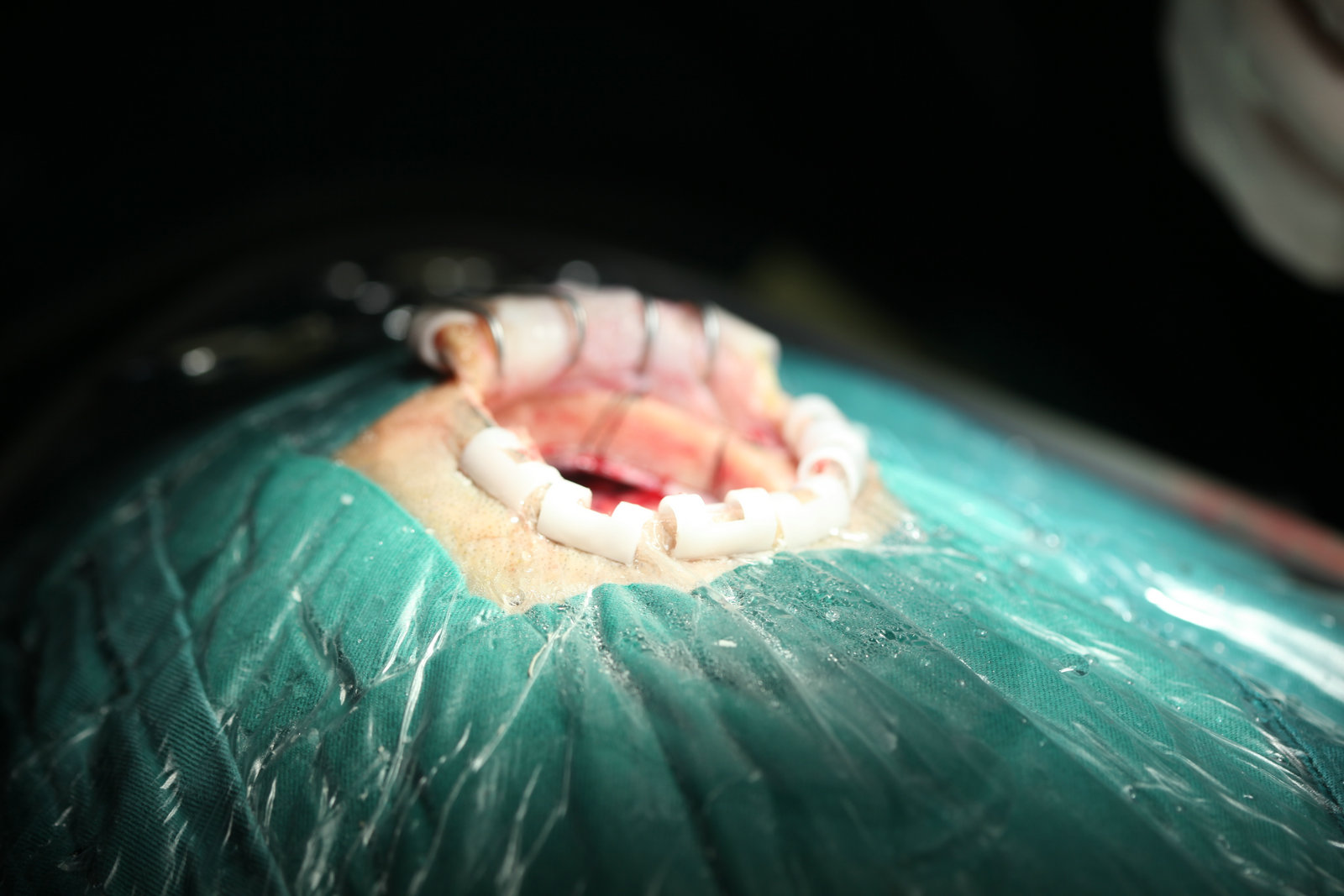 神经外科纪实视频,显微神经外科手术费用