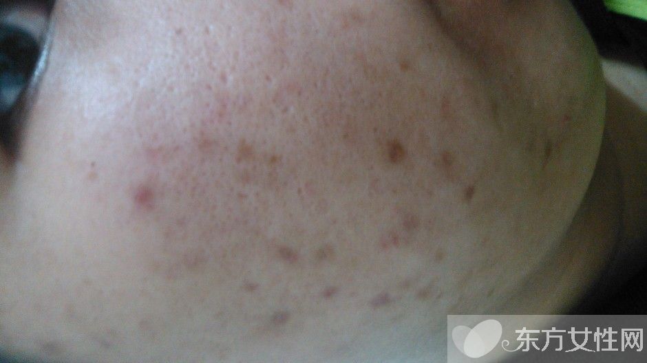 怎么祛痘疤最有效的方法,如何祛痘印痘疤效果最好