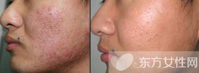 怎么祛痘疤最有效的方法,如何祛痘印痘疤效果最好
