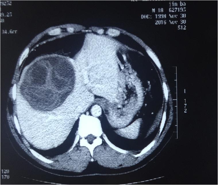 肝包虫微创手术,301医院肝肿瘤射频消融