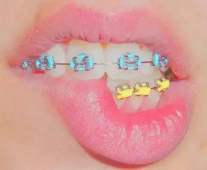 关于牙套上的橡皮筋,你需要知道的都在这